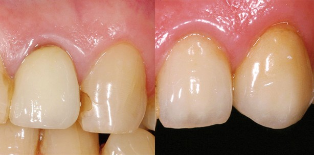 Postendodontische Versorgung: Ästhetisch und funktionell