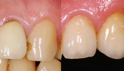 Postendodontische Versorgung: Ästhetisch und funktionell