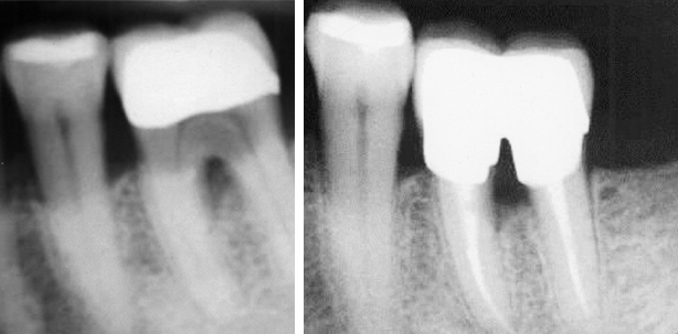 Die Prämolarisierung als zahnerhaltende Maßnahme