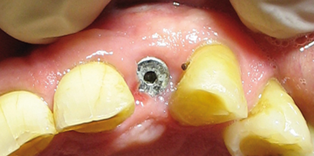 Prävention von Komplikationen in der Implantologie