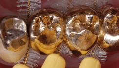 Prävention parodontaler und periimplantärer Erkrankungen