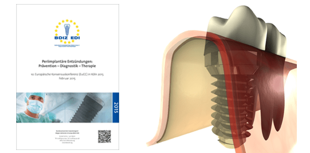 Neuer Praxisleitfaden für den Umgang mit periimplantärer Entzündung