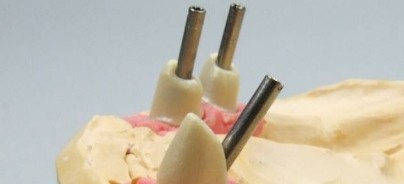 Emergenzprofil-Technik bei extremen Implantationen