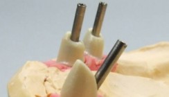 Emergenzprofil-Technik bei extremen Implantationen