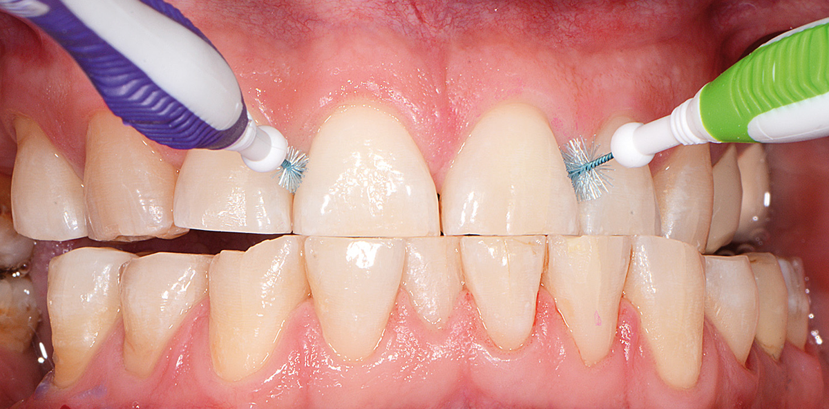 hausliche und professionelle behandlung bei leistungssport patienten zwp online das nachrichtenportal fur die dentalbranche