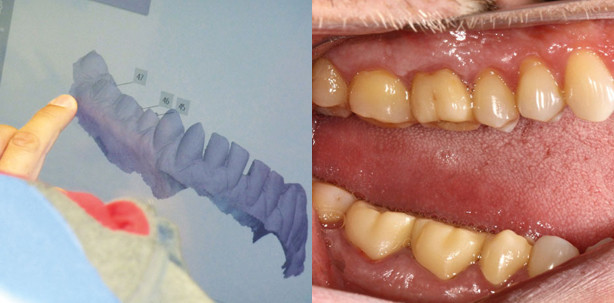 Digitale Prothetik: Präzise Funktion per Intraoralscanner