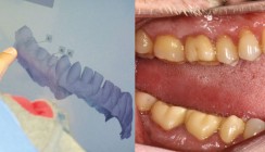 Digitale Prothetik: Präzise Funktion per Intraoralscanner