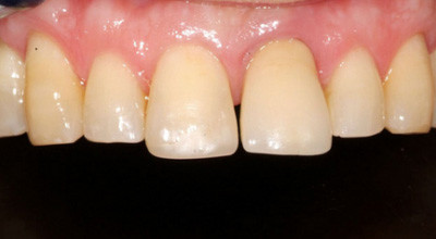 Ästhetische Versorgungen mit Kronen und Brücken