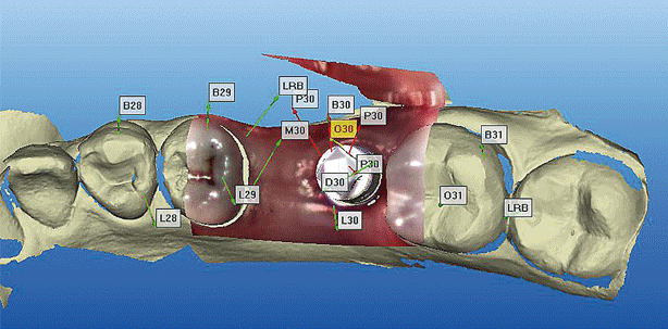Prothetik im digitalen Zeitalter
