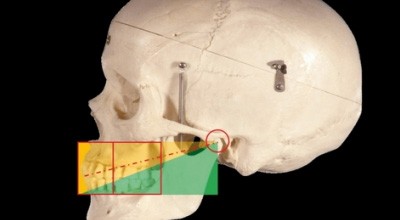 Prothetikerfolg durch Präzisionsmodelle