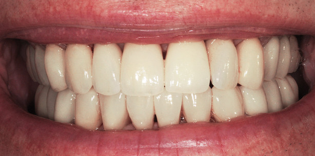 Ästhetische Rehabilitation komplexer Fälle – eine Teamleistung!