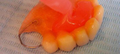 Prothetische Planung: Digital einfach und schnell ans Ziel