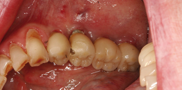 Ergänzende Parodontaltherapie mit Photothermischer Therapie