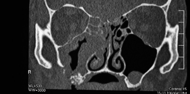 Pott's Puffy Tumor nach Sinuslift - Ein ungewöhnlicher Fall