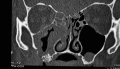 Pott's Puffy Tumor nach Sinuslift - Ein ungewöhnlicher Fall