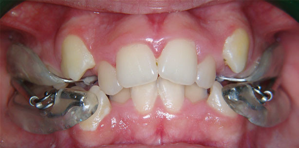 Neue Generation herausnehmbarer Apparaturen