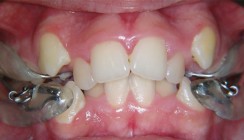 Neue Generation herausnehmbarer Apparaturen