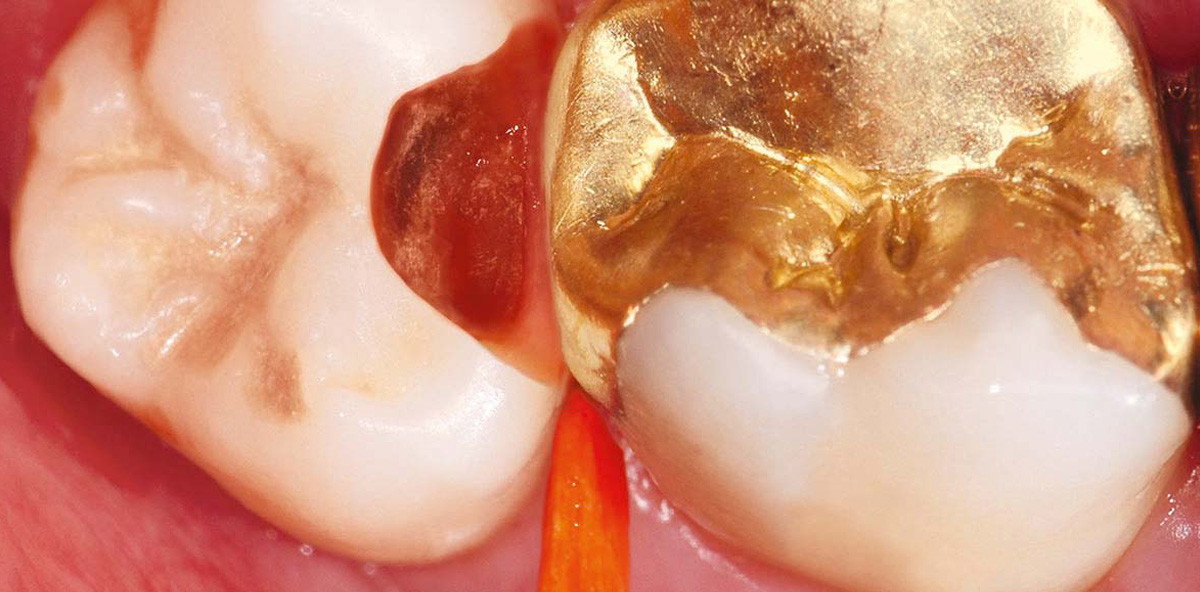 Selektive Kariesexkavation zur Vitalerhaltung der Pulpa