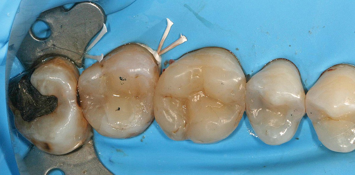 Direkte Überkappung 2.0 – Vitale Pulpatherapie