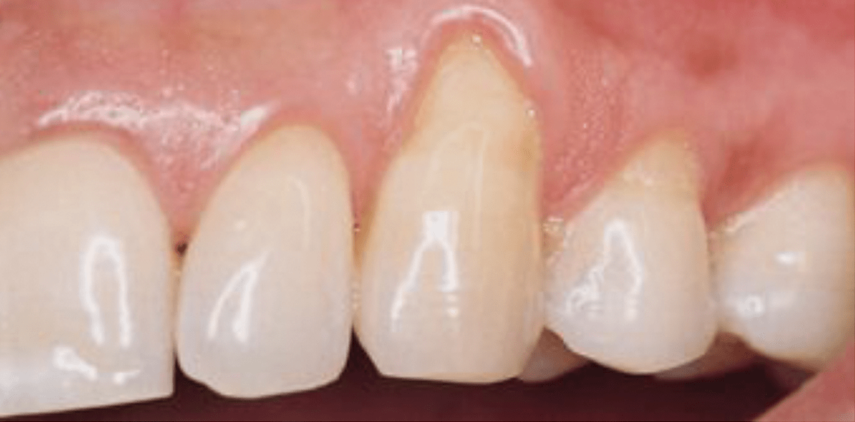 Erhaltungstherapie: Niedrigabrasives Pulver auf Erythritolbasis