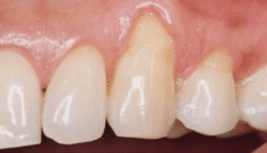 Erhaltungstherapie: Niedrigabrasives Pulver auf Erythritolbasis