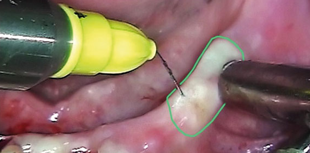 Punktgenaue Schmerzausschaltung: ein Plus für Patient und Behandler