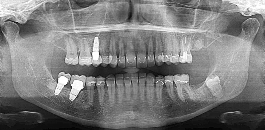 Vier-Quadranten-Rehabilitation