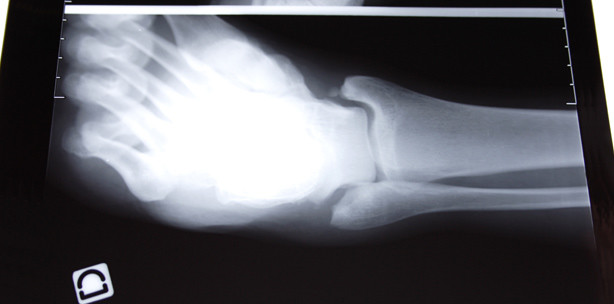 Rachitis: In der Sonne Knochen schützen