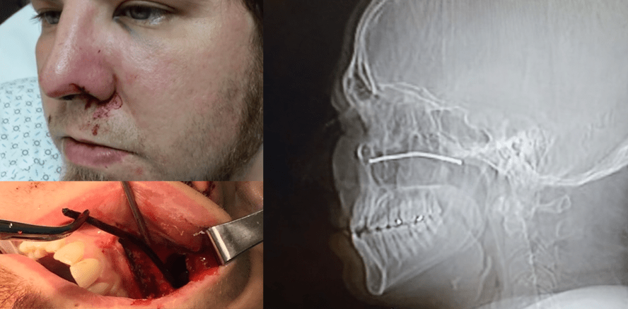 Metallstab in Kieferhöhle: Unglücklicher Unfall beim Rasenmähen