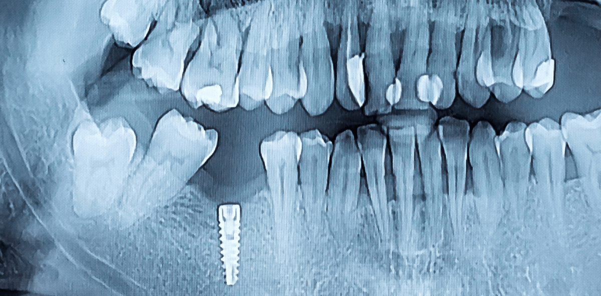 Risiko Rauchen und Osseointegration: So bleiben Implantate erhalten