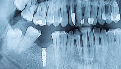 Risiko Rauchen und Osseointegration: So bleiben Implantate erhalten