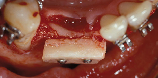 Umfassende prothetische Versorgung bei einem teilbezahnten Raucher