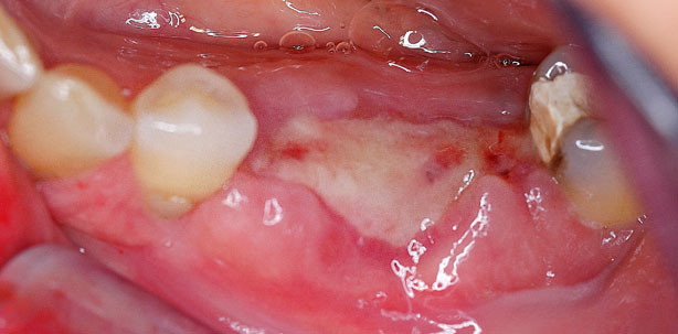 Wund-Dehiszenzen: OSSIX® PLUS Membran bietet besonderen Schutz