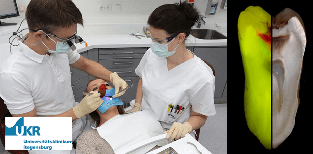 Mit fluoreszierendem Licht gegen kariöses Dentin