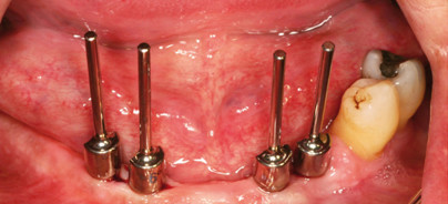 Implantatprothetische Rehabilitation ­