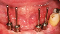 Implantatprothetische Rehabilitation ­