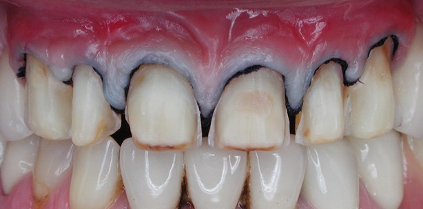 Rehabilitation einer OK-Front mit Verschiebelappen und Veneers