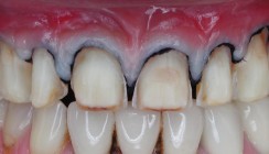 Rehabilitation einer OK-Front mit Verschiebelappen und Veneers