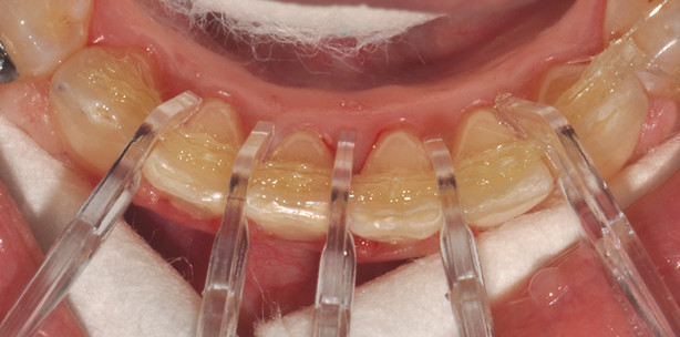 Vorimprägniertes Glasfaserband in der Kieferorthopädie