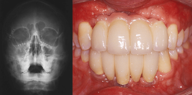Implantatprothetische Rehabilitation nach Frontzahnverlust