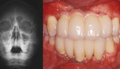 Implantatprothetische Rehabilitation nach Frontzahnverlust