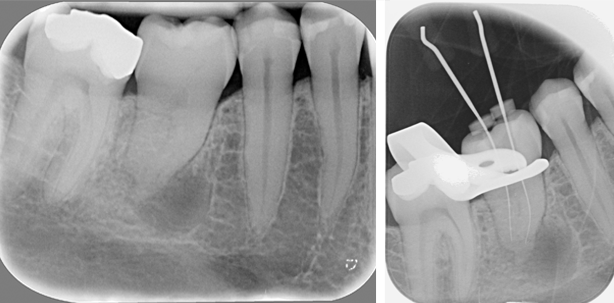 Behandlung eines replantierten Weisheitszahnes