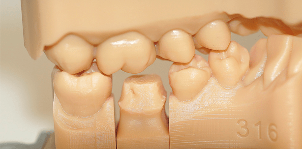 Einzelzahnrestaurationen mit Resin-Nanokeramik