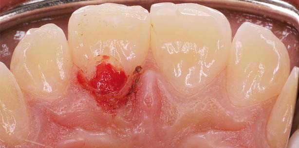 Therapie externer zervikaler Resorption