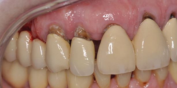 Restaurative Maßnahmen bei älteren Menschen