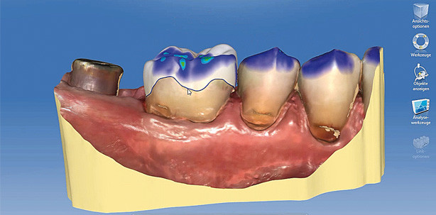 Restauration mittels minimalinvasiver Inlays und Onlays