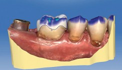 Restauration mittels minimalinvasiver Inlays und Onlays