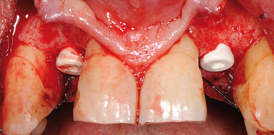 Reversibel verschraubtes Keramikimplantat im Frontzahnbereich