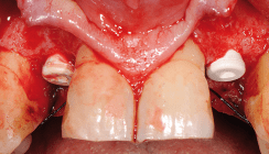 Reversibel verschraubtes Keramikimplantat im Frontzahnbereich