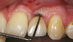 Weichgewebsmanagement bei Rezessionen am Frontzahnimplantat